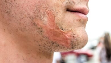 Are Burn Scars Permanent?