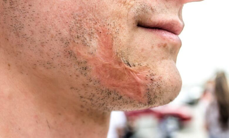 Are Burn Scars Permanent?